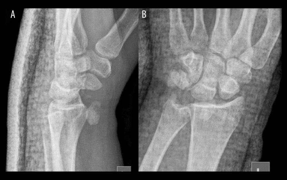 (A) Lateral wrist preoperative X-ray, the volarly displaced fragment is visible, (B) Anteroposterior wrist preoperative X-ray.