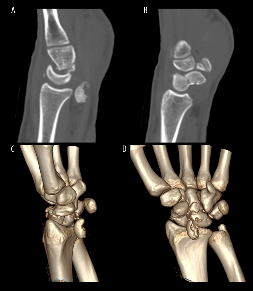 Wrist CT scan (A) sagittal plane, capitate fragment migration is visible, (B) sagittal plane, scaphoid fracture is visible, (C, D) 3d-reconstruction, scaphoid and capitate fracture are visible.