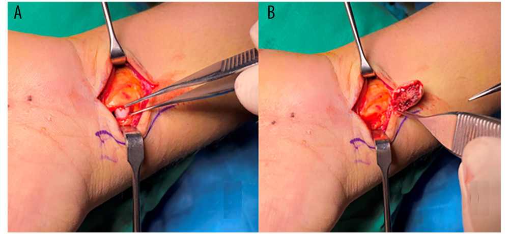 (A) Volarly displaced capitate fragment deep to the median nerve, (B) Capitate fragment after removal.