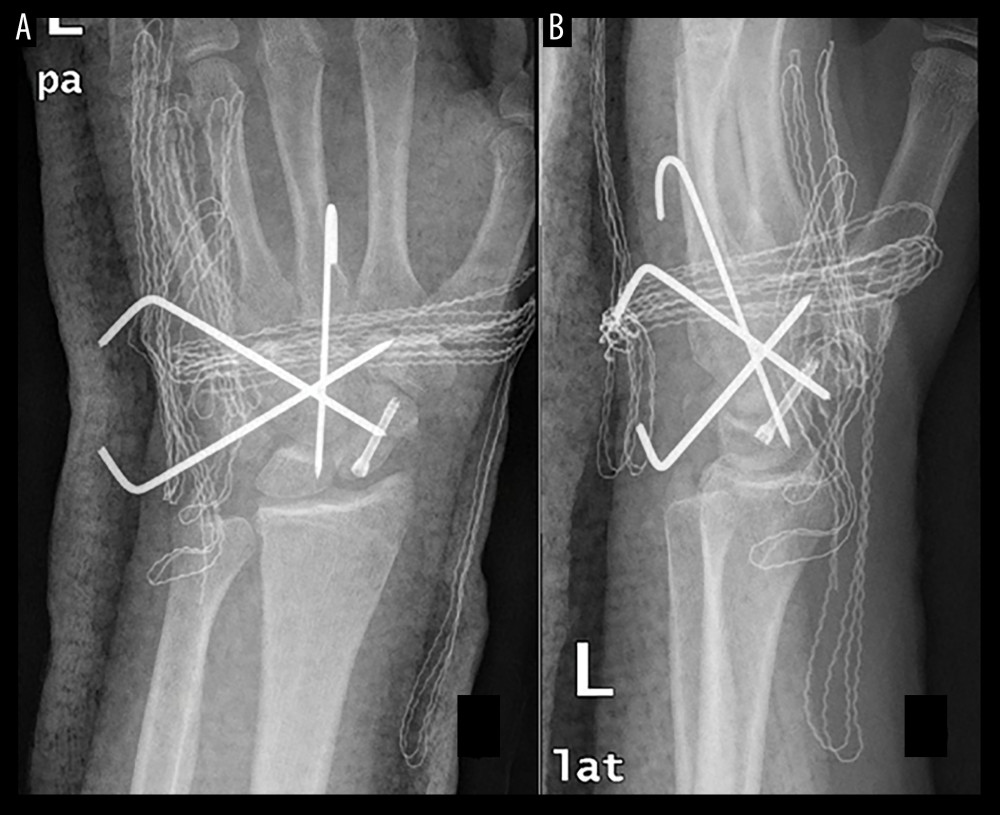 (A) Postoperative anteroposterior wrist X-ray, (B) Postoperative lateral wrist X-ray. Good fracture reduction with 3 K-wires and a Herbert screw is visible.
