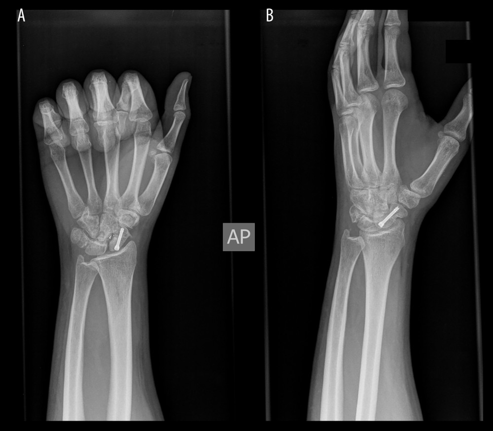 (A) Anteroposterior 1-year postoperative wrist X-ray, (B) Lateral 1-year postoperative wrist X-ray. Good fracture healing and carpal bones alignment are visible.