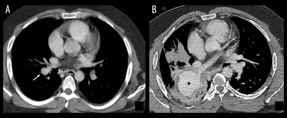 (A) Chest CT scan showing a right inferior lobar artery aneurism in 2017 measuring 18 mm (white arrow). (B) Chest CT scan of the same patient in 2023 showing a massive enlargement of the aneurysm measuring 52×33 mm with concentric thrombotic appositions (asterisk).