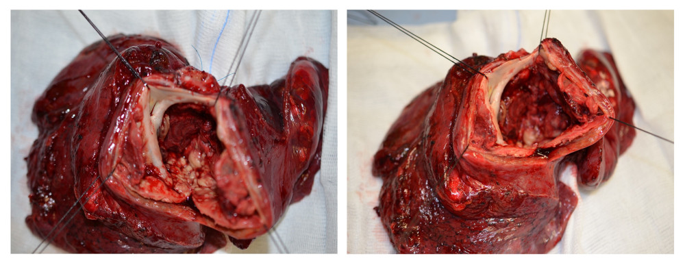 Intraoperative images. The images show the right inferior lobar aneurysm after its section and exposure. The pathological dilatation of the artery involving all the 3 layers of the vessel wall is obvious, along with the thrombotic appositions.