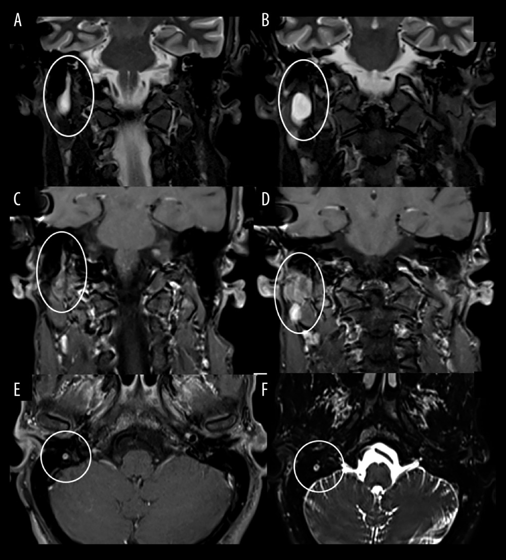 Magnetic resonance imaging scan of the head. (A, B) T2-weighted very hyperintense, homogenous, almost cystic lesion, with (C, D) only minor peripheral and partly septal contrast-enhancement. (E, F) The lesions extend into the right facial canal’s widened mastoid segment and (B, D) present with a mass in the extratemporal segment. (A, B) T2-weighted fat-suppressed inversion recovery sequence in coronal view. (C–E) T1-weighted fat-suppressed dixon sequence with contrast-enhancement in (C, D) coronal and (E) axial view. (F) High-resolution T2-weighted SPACE fat-suppressed sequence in axial view.