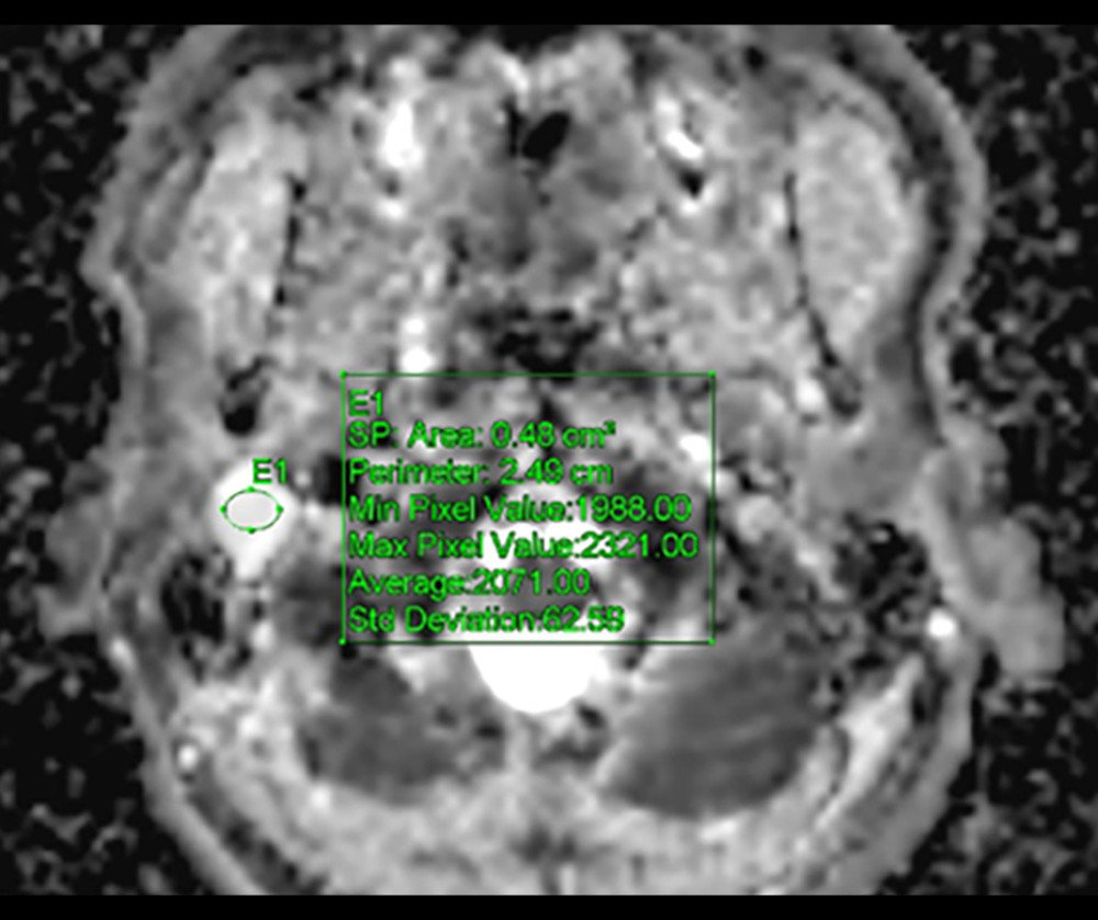 Apparent diffusion coefficient (ADC). High ADC supports the diagnosis of a facial schwannoma (average ADC value: 2.1×10–3 mm2/s).