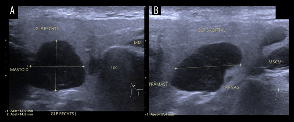 Ultrasound image of the right parotid gland in (A) transversal and (B) sagittal plane. Both images show an intraparenchymal, sharply circumscribed, anechoic, homogeneous, lobulated mass with dorsal sound enhancement extending from the mastoid. The mass measures 13.9×14.8×17.4 mm. GLP righ – parotid gland; UK – mandible; MM – musculus masseter.
