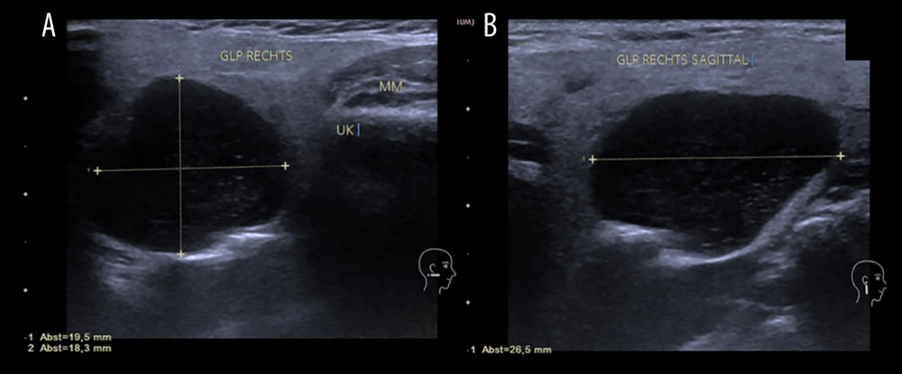 Ultrasound findings in the (A) transversal and (B) sagittal plane. Ultrasound images reveal a mass of similar morphologic ultrasound criteria as previously described: intraparenchymal in the parotid gland showing a sharply circumscribed, anechoic, dorsal ultrasound enhancement, measuring 19.5×18.3×26.5 mm.