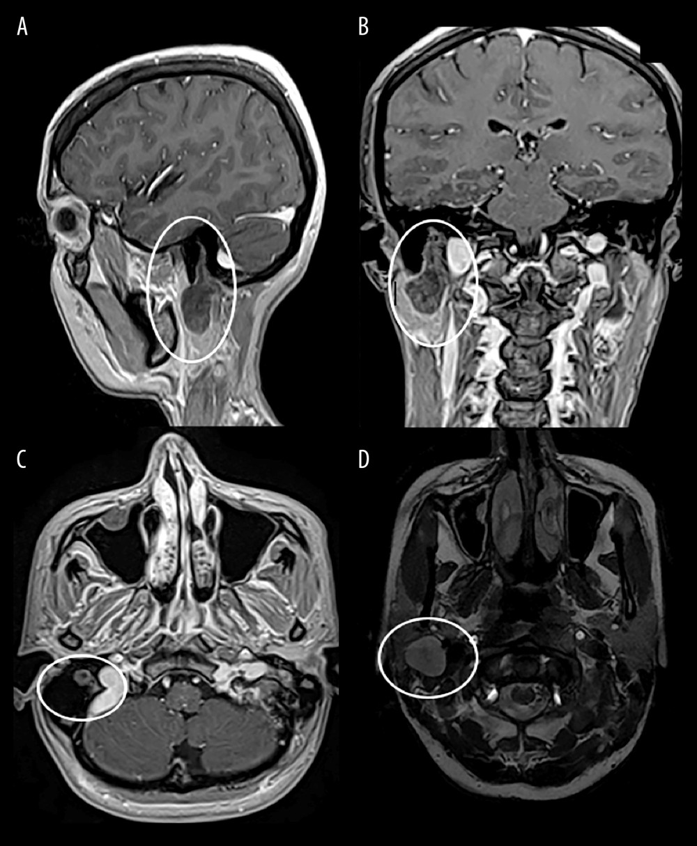 Magnetic resonance imaging scan of the head. (D) T2-weighted moderate hyperintense, homogenous lesion with (A–C) only minor peripheral and part central contrast enhancement. (A–D) The lesions again extend into the widened mastoid segment of the right facial canal and present with a mass in the extratemporal segment. (A–C) T1-weighted contrast-enhanced magnetization prepared-rapid gradient echo (MP-RAGE) sequence in 3-dimensional reconstruction (sagittal, coronal, axial). (D) High-resolution T2-weighted constructive interference in steady state (CISS) sequence in axial view without contrast enhancement.
