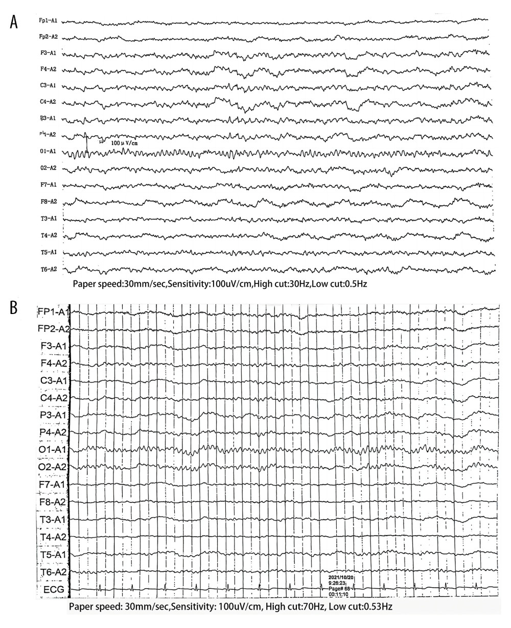 The abnormal recorded electroencephalograms (EEGs) at admission. During the patient’s first hospitalization, the EEG showed slow and sustained activity on the right side, as indicated by delta waves (A). During the second hospitalization, the EEG revealed constant low voltage in the anterior head leads, which was clearer in right side recording (B).
