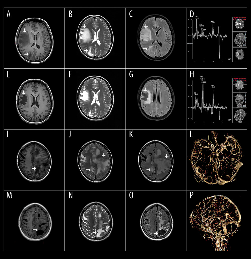 Brain images obtained on admission. Magnetic resonance imaging (MRI) at initial presentation revealed multiple abnormal lesions in the right frontoparietal lobe (white arrows), characterized by low signal intensity on T1-weighted sequences (A) and high signal intensity on T2-weighted sequences (B) and fluid-attenuated inversion recovery (FLAIR) sequences (C). The exact nature of these lesions remained uncertain. No notable abnormalities were observed in the N-acetyl-aspartate (NAA) and choline (Cho) peaks, while an inverted lactate peak was detected at 1.33 ppm (D). A follow-up brain MRI performed 20 days later revealed a decrease in T1 signal (E), an increase in T2 signal (F), and a decrease in FLAIR signal (G) in the right frontal lobe lesion compared with the initial examination (A–C), indicating liquefaction and necrosis. Magnetic resonance spectroscopy (MRS) revealed reduced NAA peak and abnormal lactate peak (H). During a second attack over a month later, new abnormal signal shadows (white arrows) in the right parietal lobe and left frontotemporal and parieto-occipital lobes in comparison with the initial hospitalization were obvious (I–K). The adjacent brain tissue was compressed, causing a shift of midline structures to the right (black arrow). The observed lesions exhibited characteristics consistent with vascular distribution. Subsequent analysis of computed tomography angiography and computed tomography venography did not reveal any significant abnormalities in the major blood vessels (L, P). After 15 days of treatment, a follow-up MRI showed the smaller focus with signs of necrolysis and liquefaction (M–O), prompting consideration of thrombosis or inflammation in small blood vessels leading to tissue necrosis.