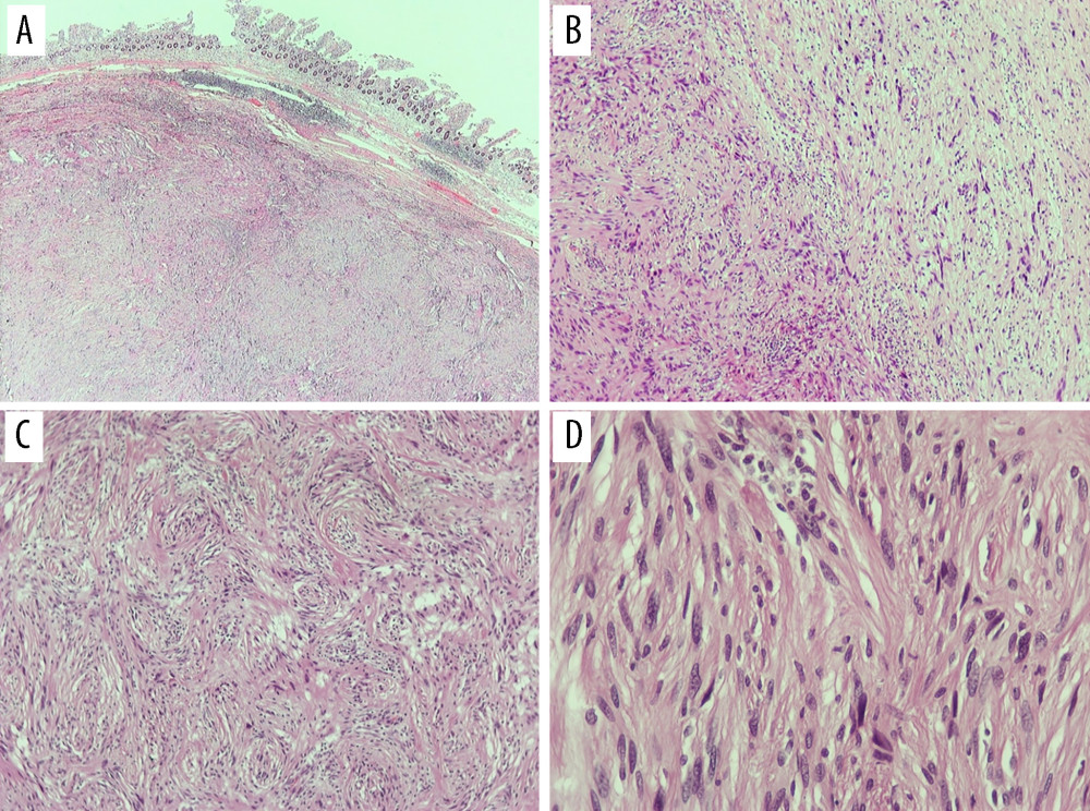 (A–D) Histologic analysis of the benign jejunal schwannoma in a 57-year-old woman. Hematoxylin and eosin stains, (20–400× magnifications), showing the submucosal neoplasm below the intestinal mucosa (A) showing areas of mild cellularity and moderate cellularity (B). The neoplastic cells were arranged in fascicles and whorls (C) and they show spindle to ovoid nuclei with focal mild pleomorphism (Antoni A type), without increased mitotic activity (D).