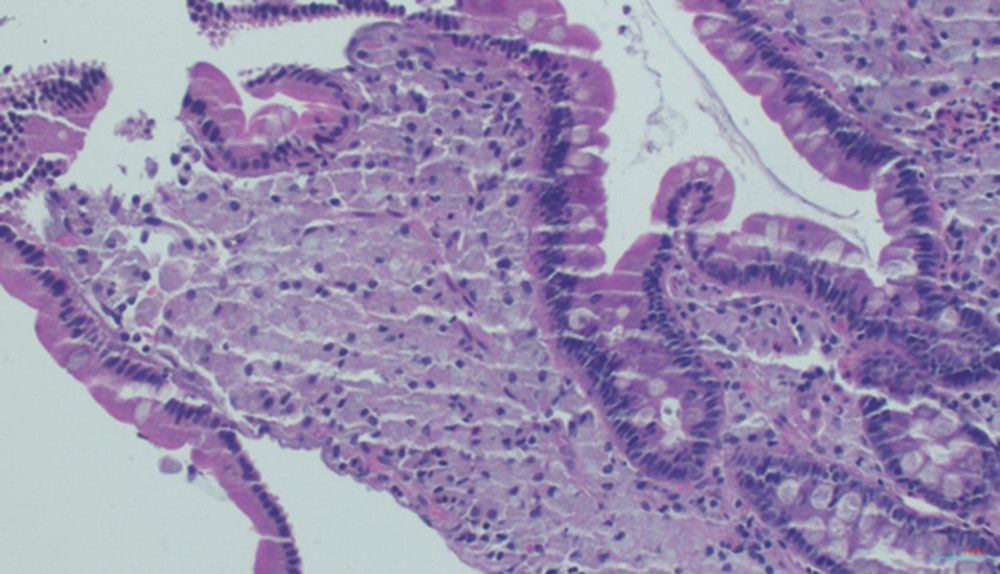 A photomicrograph of the endoscopic small-bowel biopsy in a 40-year-old man with Whipple disease. The lamina propria contains pink foamy macrophages with granular cytoplasm. Hematoxylin and eosin (H&E). Magnification ×40.