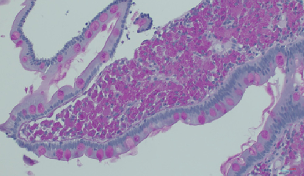 A photomicrograph of the endoscopic small-bowel biopsy in a 40-year-old man with Whipple disease. Periodic acid-Schiff (PAS) staining show PAS-positive foamy macrophages without an inflammatory cell infiltrate, which is typical for Whipple disease. PAS. Magnification ×40.