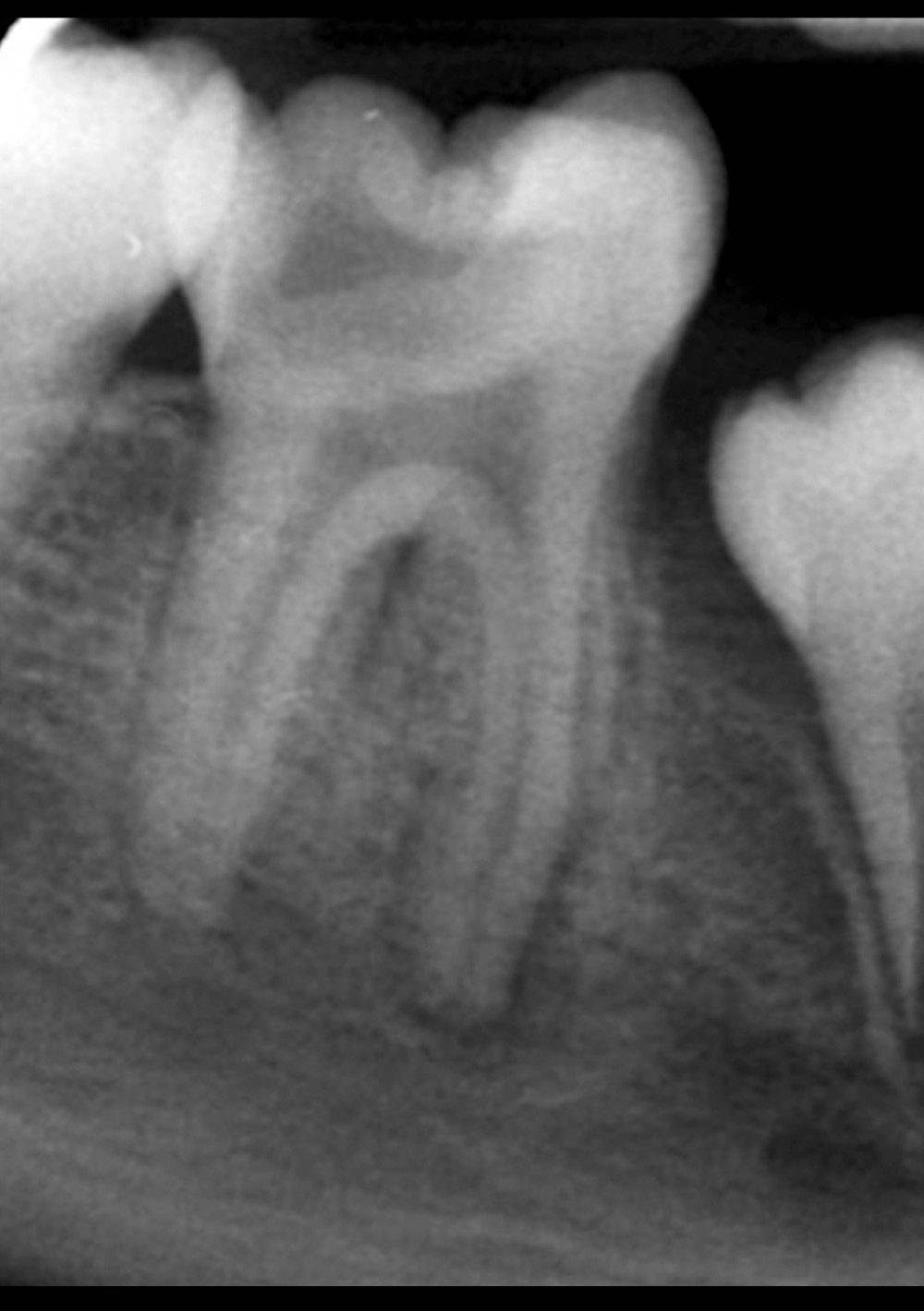 Preoperative intraoral periapical radiograph of a mature mandibular right first permanent molar tooth, revealing deep caries approaching the dental pulp with presence of periapical radiolucency and broken lamina dura around the mesial and distal roots, with a PAI score of 4.