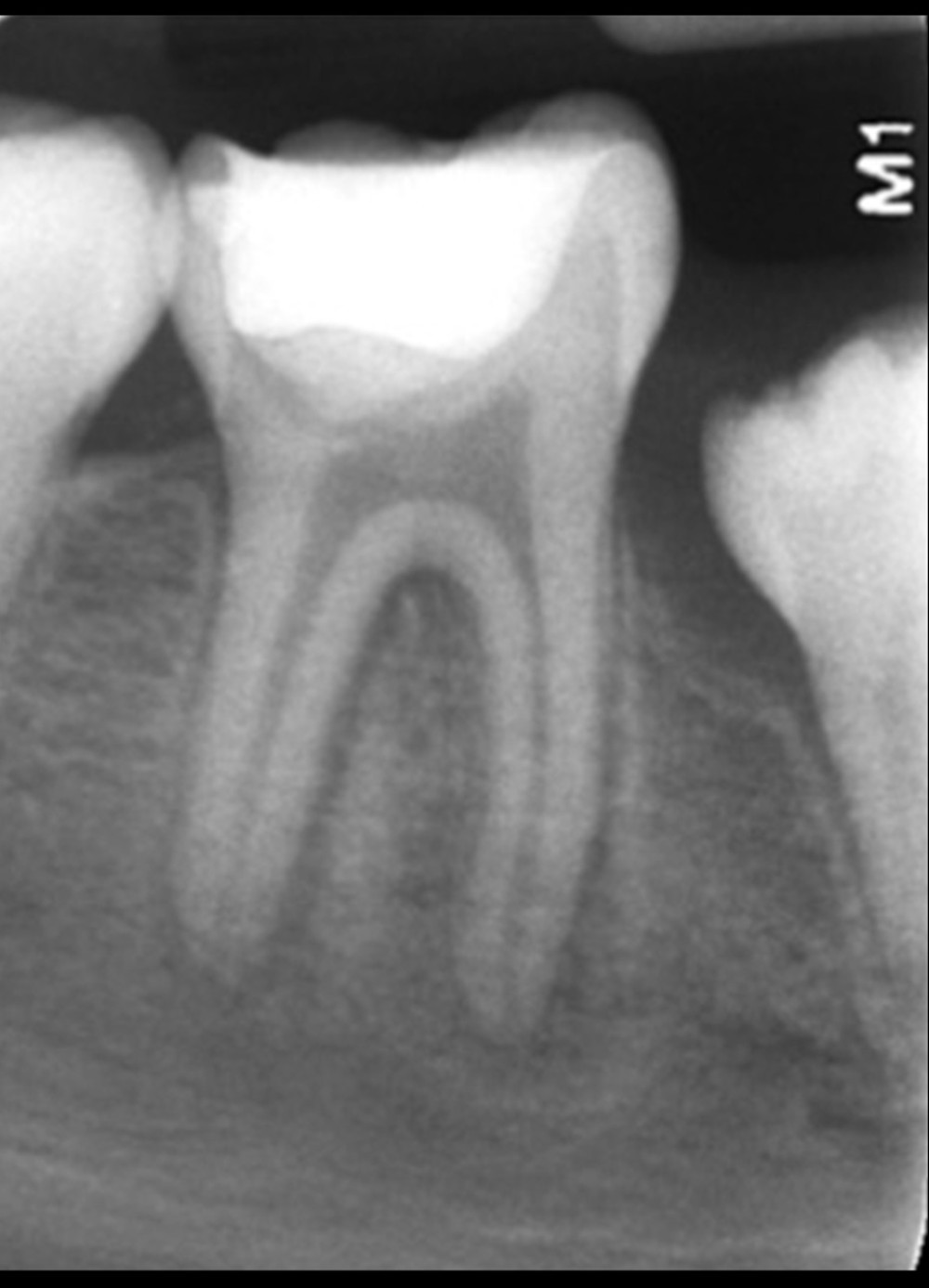 Immediate postoperative intraoral periapical radiograph showing permanent composite restoration over the Biodentine, which was used as a capping material covering the dental pulp tissue.