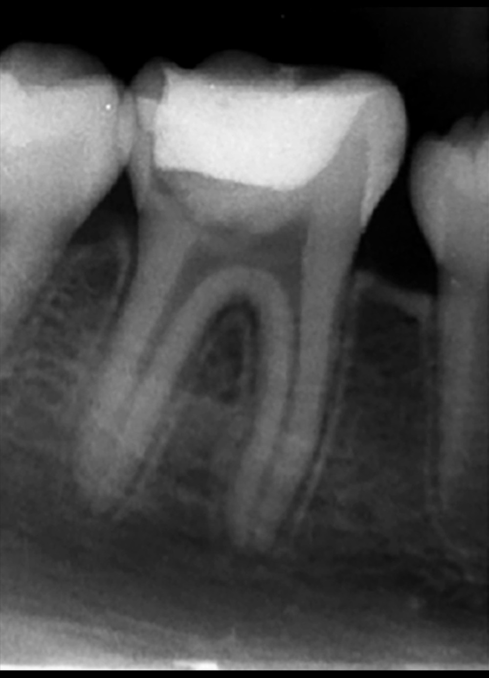 At 6 months after the procedure, an intraoral periapical radiograph revealed normal bone features with complete periapical pathology healing and development of intact lamina dura around the mesial and distal roots.