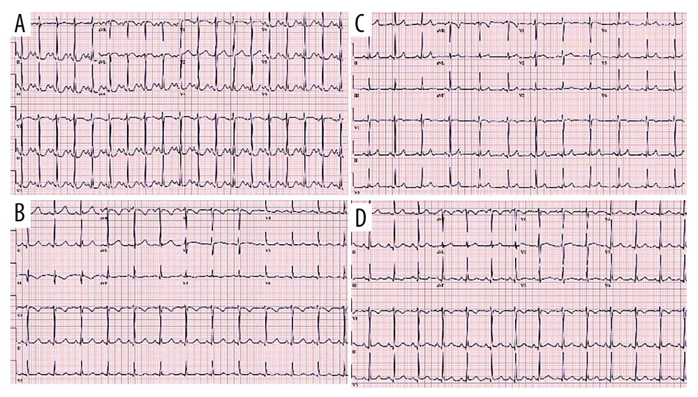 Electrocardiogram changes associated with electrolyte abnormalities. Prolonged QT interval, which progressively normalized throughout admission.