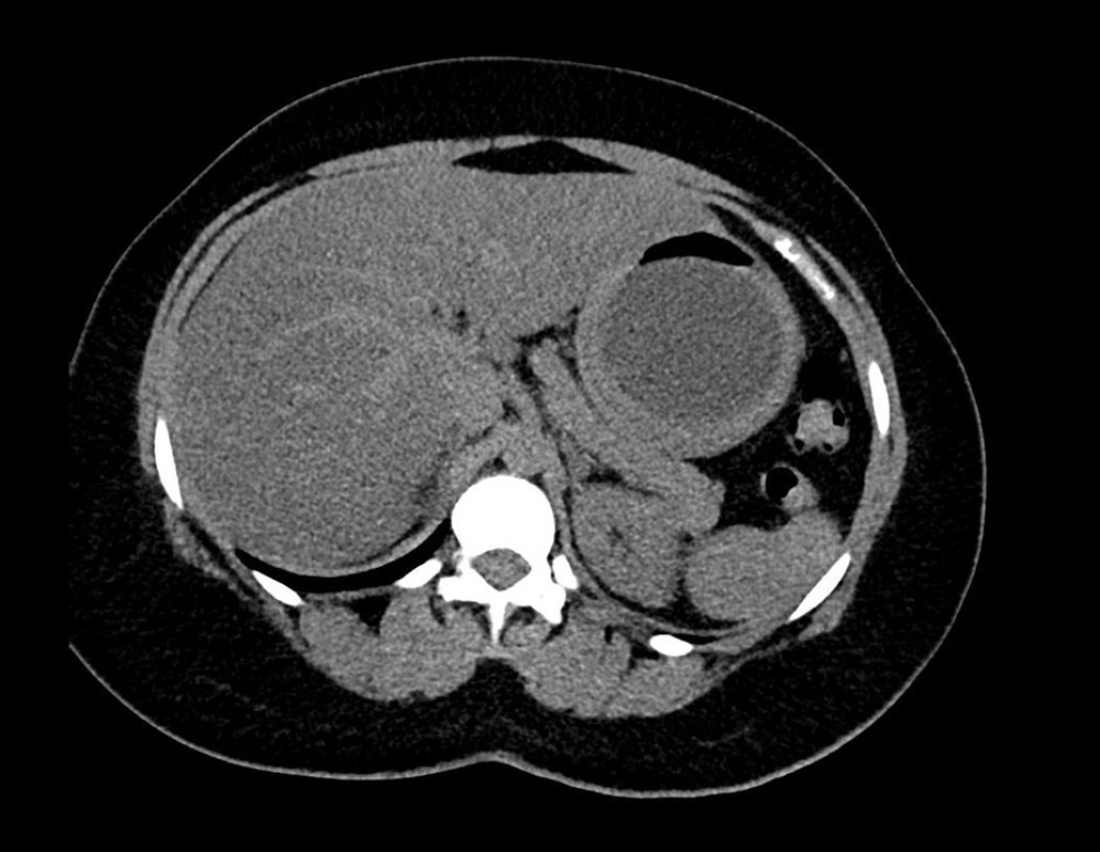 Abdominal computed tomography scan showing gastric distention, with a dilated intraluminal balloon device in place.