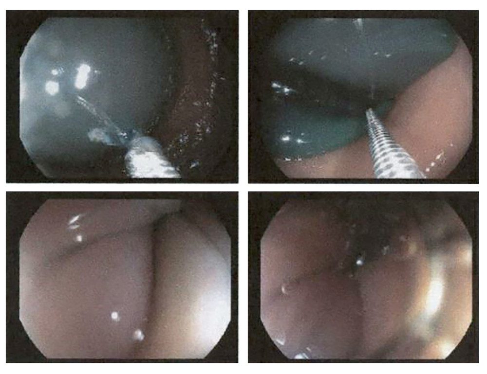 Esophagogastroduodenoscopy showing intragastric balloon in place. The balloon obstructs the pylorus, causing gastric outlet obstruction.
