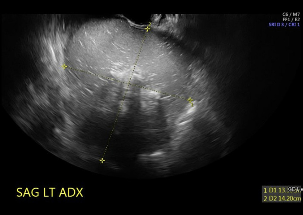 Transvaginal ultrasound, with large suspected cystic teratoma measuring 19.9×13.3×14 cm with a volume of 1373 cm3.