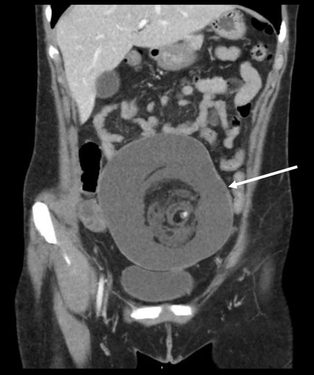 Coronal computed tomography scan with large cystic teratoma measuring 10.1×13.2×15.9 cm and fat stranding along the superior right aspect of the dermoid at the level of the umbilicus. Normal appendix shown. Arrow points to pelvic mass.