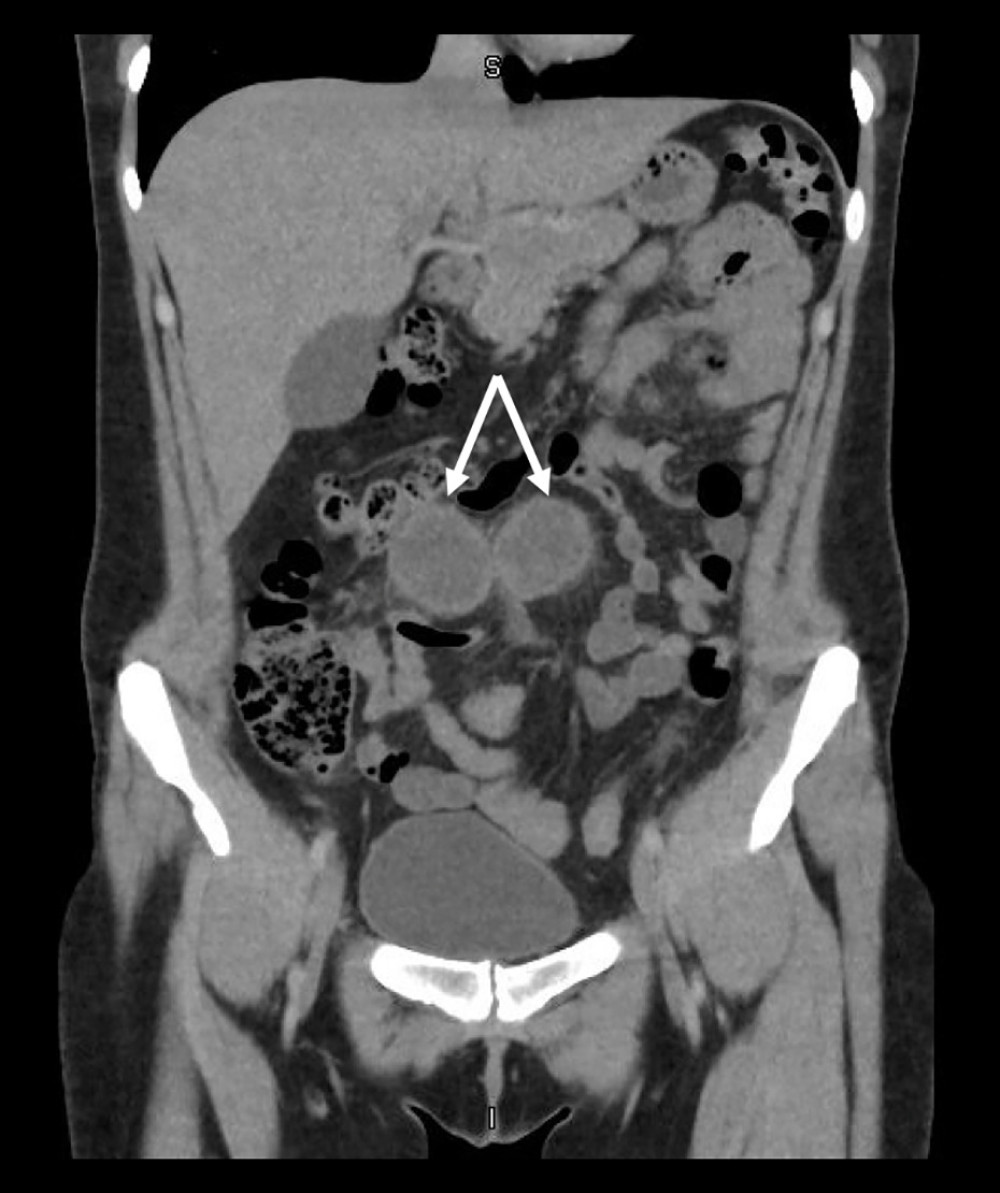 Coronal computed tomography scan with bilobed midline anterior abdominal wall masses both measuring 5×4×4 cm. Arrow points to bilobed masses.