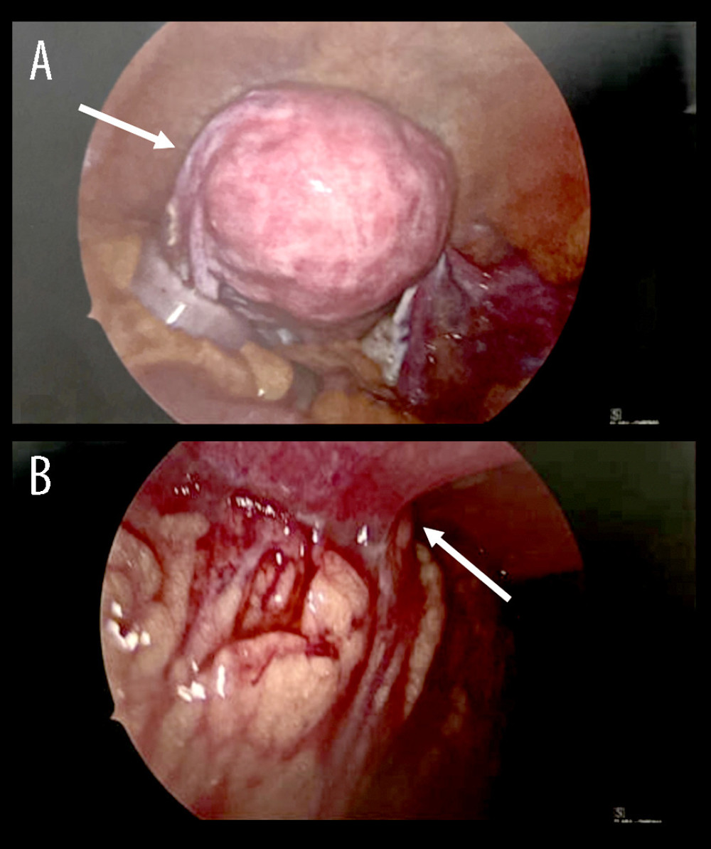 Diagnostic laparoscopy via Palmer’s point. (A) Normal pelvic anatomy with surgically absent left fallopian tube, as detailed by the arrow, and ovary and no gross intraperitoneal lesions. (B) Large omental adhesion, highlighted by the arrow, to the anterior abdominal wall containing transverse colon and suspected abscesses.