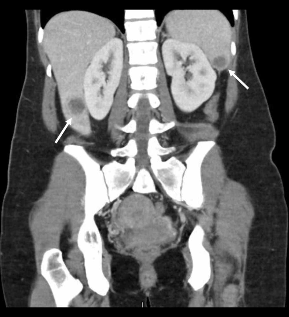 Abdominopelvic computed tomography scan, with numerous heterogeneous soft tissue masses solid in appearance with central necrosis in the mesentery, pelvic inlet, liver, and spleen suspicious for metastatic disease. Liver lesion measures 1.4×2.1×2.7 cm. Arrows detail location of the soft tissue metastases.