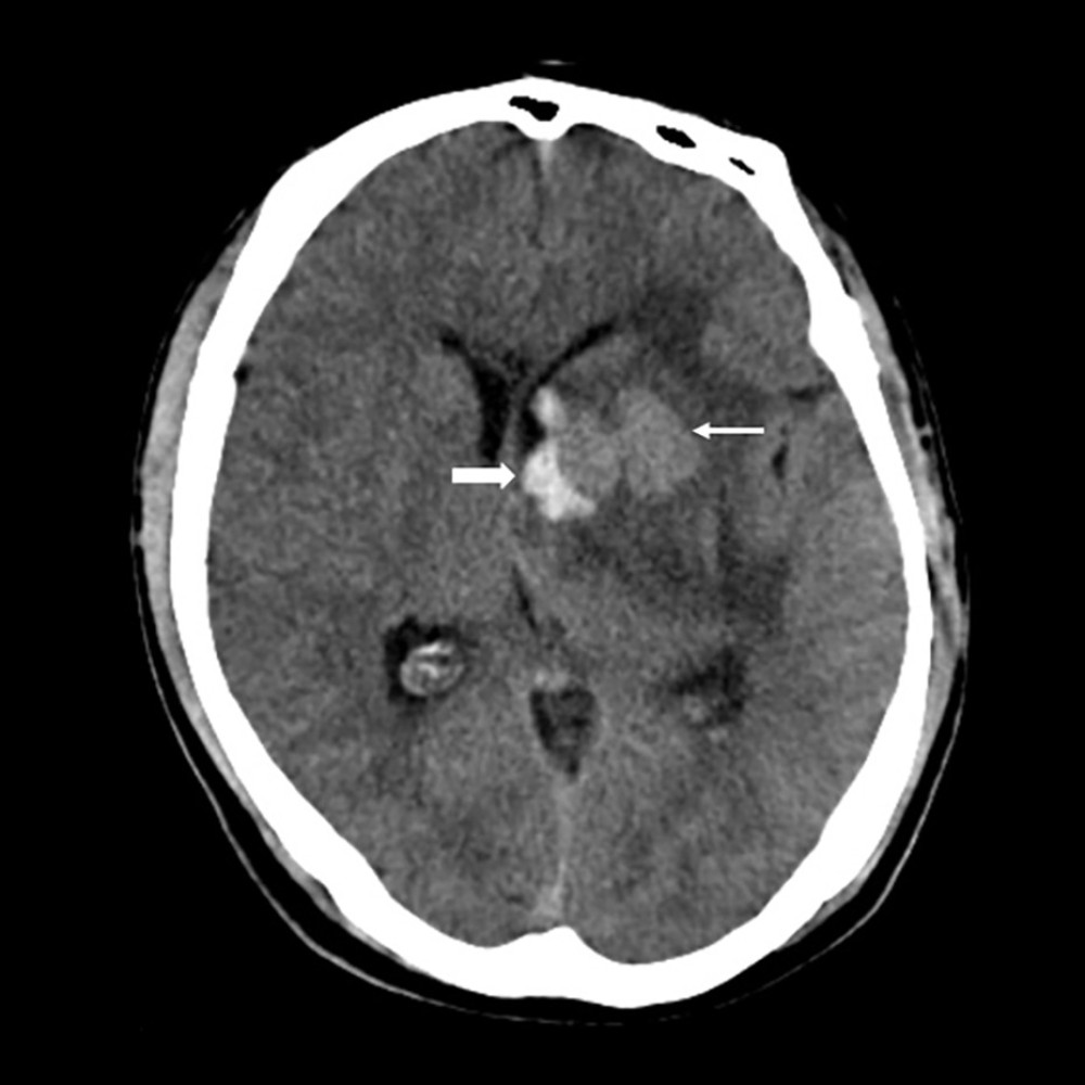 Non-contrast 64-slice computed tomography revealing an expansive hyperdense lesion (thin arrow) located on the left basal ganglia with surrounding edema, in association with an adjacent hyperdense collection (thick arrow) suggestive of parenchymatous and intraventricular hemorrhage.