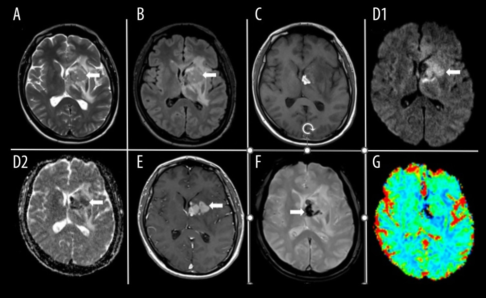 1.5 T MRI. A–C: Axial MRI T2-weighted images (A) and FLAIR images (B) showing a low-signal mass on the left basal ganglia (arrows), with associated isointensity (C) on T1-weighted images. D: This lesion revealed high signal on DWI (D1) with a corresponding low signal on the ADC map (D2), consistent with restricted diffusion (arrows). E–G: On post-contrast T1-weighted images (E), there was a homogenous enhancement of the lesion (arrow). Axial T2* images (F) depicted the hemorrhagic component, represented by marked hyposignal (arrow). No significant rCBV alterations were noted (G). Altogether, these findings were suggestive of lymphoma with associated hemorrhage. MRI – magnetic resonance imaging; FLAIR – fluid-attenuated inversion recovery; DWI – diffusion-weighted imaging; ADC – apparent diffusion coefficient; rCBV – relative cerebral blood volume.