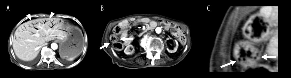 Contrast-enhanced abdominal computed tomography findings associated with the patient’s first episode of abdominal pain. (A) Low-density areas with air density in the portal veins can be observed in the left hepatic lobe and peripheral portion of the right anterior lobe (arrowheads). (B) Low-density areas in the intestinal wall exhibit bubble-like formations (arrows). (C) An enlarged view of a portion of Figure B (arrows) shows the bubble-like appearance in greater detail.