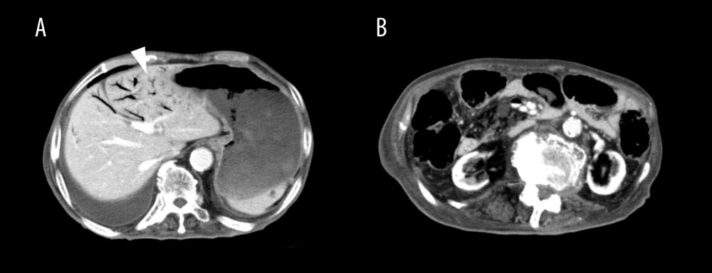 Contrast-enhanced abdominal computed tomography findings associated with the patient’s second episode of abdominal pain. (A) A low-density area with air density in the portal vein is observed in the left hepatic anterior lobe and anterior segment of the right he patic lobe (arrowhead). (B) A slight amount of ascites is noted in the absence of low-density areas in the intestinal wall and small intestinal distension.