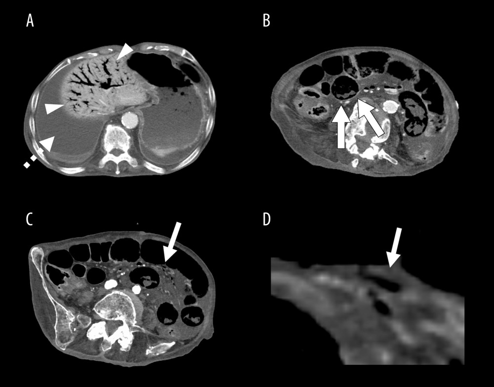 Contrast-enhanced abdominal computed tomography findings associated with the patient’s third episode of abdominal pain. (A) Low-density areas with air density in the portal veins are widely observed in both hepatic lobes, including in the right posterior segment (arrowheads). A water density area suggests a considerable amount of ascites (dashed arrow). (B, C) Linear low-density areas in the intestinal wall indicate the presence of linear pneumatosis intestinalis (arrows), resulting in the demise of the patient. (D) An enlarged view of Figure C shows the linear appearance of gas in the intestinal wall in greater detail (arrow).