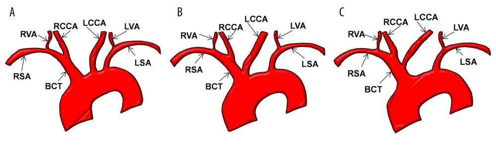(A); Type I Aortic arch. (B); Type II bovine aortic arch and (C); Type II bovine aortic arch variant. BCT – brachiocephalic trunk; RSA – right subclavian artery; RVA – right vertebral artery; RCCA – right common carotid artery; LCCA – left common carotid artery; LVA – left vertebral artery; LSA – left subclavian artery (adapted from Goldsher et al [5]).