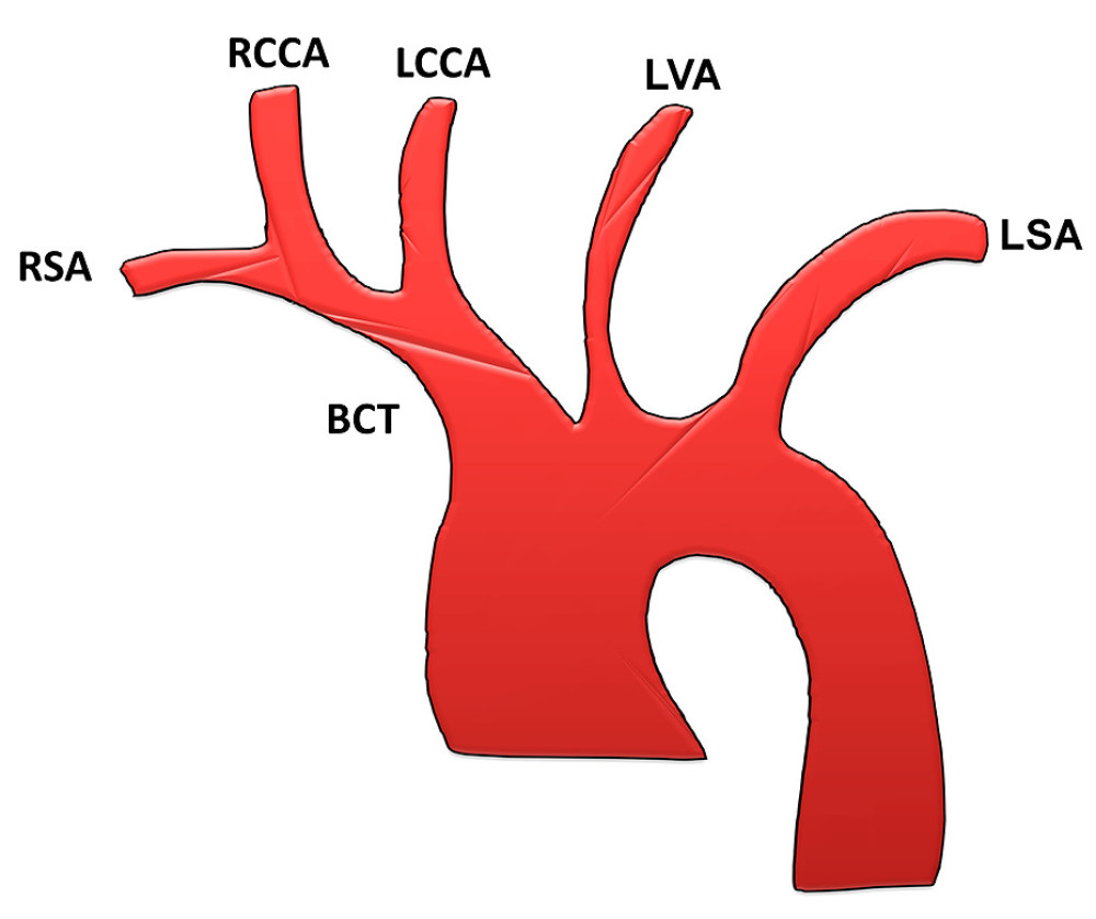Bovine aortic arch type X (Natsis classification). BCT – brachiocephalic trunk; RSA – right subclavian artery; RCCA – right common carotid artery; LCCA – left common carotid artery; LVA – left vertebral artery; LSA – left subclavian artery (adapted from Natsis et al [4]).