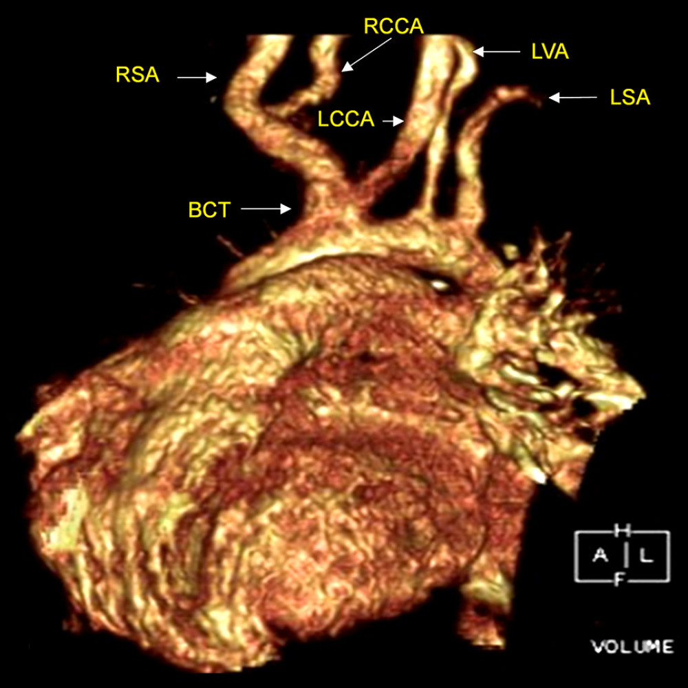 Reconstructed three-dimensional computed tomography showing the bovine aortic arch type X (Natsis classification). BCT – brachiocephalic trunk; RSA – right subclavian artery; RCCA – right common carotid artery; LCCA – left common carotid artery; LVA – left vertebral artery; LSA – left subclavian artery (adapted from Natsis et al [4]).