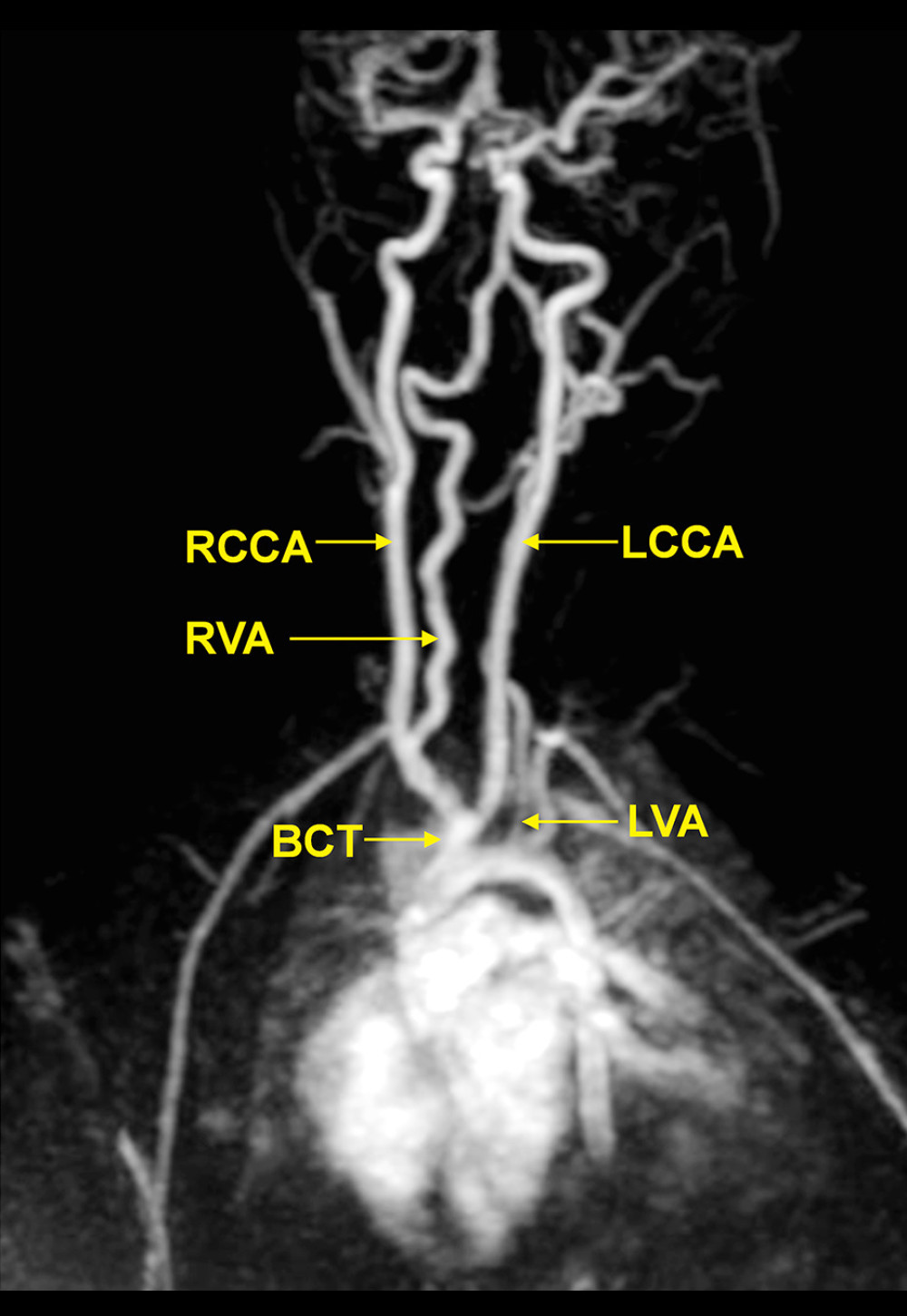 Magnetic resonance angiography demonstrates bovine type X aortic arch (Natsis classification). Origin of the right common carotid artery (RCCA) and left common carotid artery (LCCA) from the brachiocephalic trunk (BCT) and left vertebral artery (LVA) with origin in the aortic arch, not from the left subclavian artery.