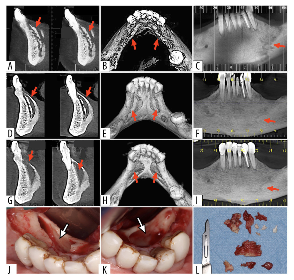 Representative images of case 8. (A, B) Computed tomography (CT) scans showing osteonecrosis in the lingual region of the mandibular symphysis, and (C) pathological fracture in the left mandibular body (arrows). (D, E) CT scans after 18 months of treatment with pentoxifylline and tocopherol showing partial bone repair of the lingual region of the mandibular symphysis, and (F) spontaneous repair of the pathological fracture in the left mandibular body (arrows). (G, H) 3-month postoperative CT scans showing the result of surgery, and (I) complete spontaneous repair of the pathological fracture in the left mandibular body (arrows). (J, K) Intraoperative views of sequestrectomy and marginal mandibular resection with piezosurgery (arrows). (L) Bone sequestrations removed from the lingual region of the mandibular symphysis.
