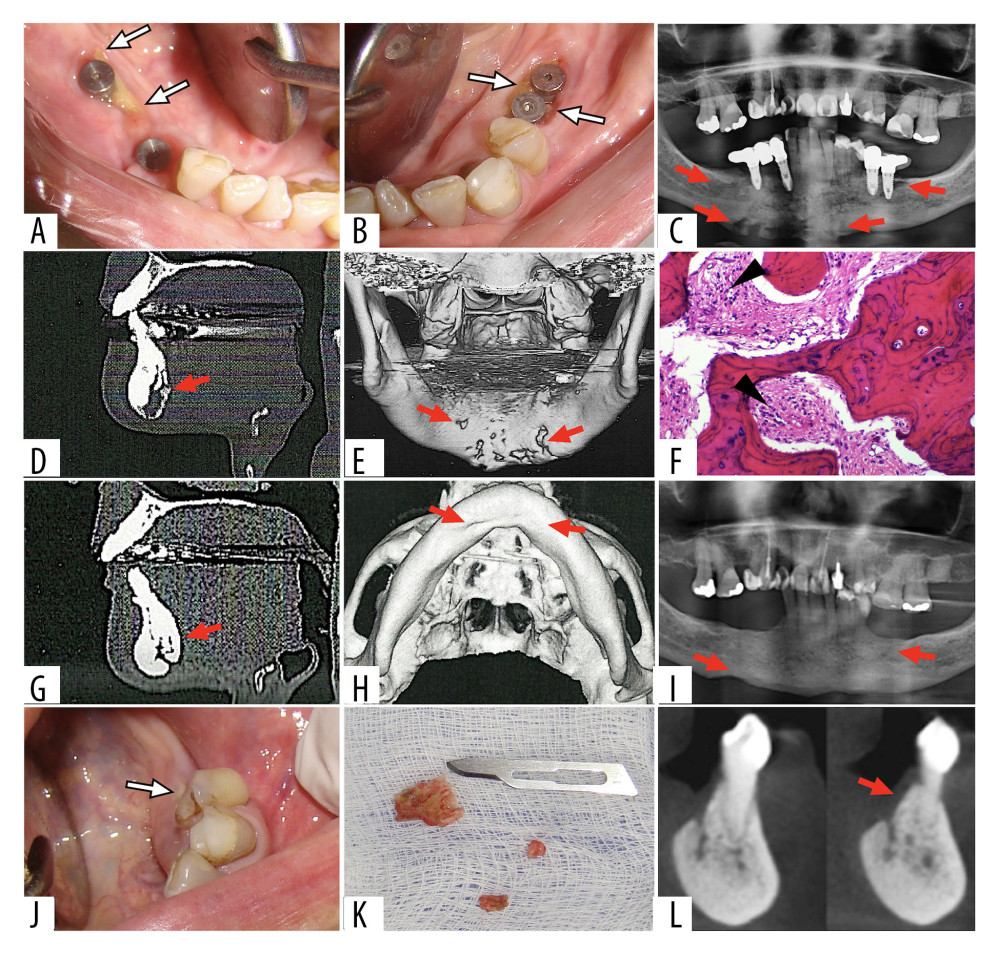 Representative images of case 4. (A, B) Sites of alveolar bone exposure around the mandibular implants that triggered the medication-related osteonecrosis of the jaw (MRONJ; arrows). (C) Panoramic view of osteonecrosis in the alveolar region (upper arrows) and at the base of the mandible (lower arrows). (D, E) Computed tomography (CT) scan showing osteonecrosis in the mandibular symphysis (arrows); (F) H&E-stained sections showing inflammatory infiltrate from mandibular bone sequestration; 400× magnification (arrows); (G) 6-month and (H) 3-year follow-up CT scan showing bone repair in the mandibular symphysis (arrows). (I) Four-year follow-up panoramic view of bone repair in the alveolar region (left arrow) and at the base of the mandible (right arrow). (J) New alveolar bone exposure due to MRONJ relapse caused by prosthetic trauma (arrow). (K) Bone sequestration removed from the relapsed region. (L) One-year follow-up CT scan showing bone repair in the relapsed region (arrow).