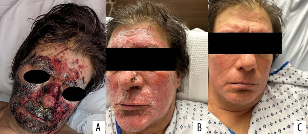 Clinical photographs of the progress of the SJS in our patient day 3 to day 17. (A) Facial lesions on day 3. (B) Facial lesions on day 10. (C) Facial lesions on day 17.
