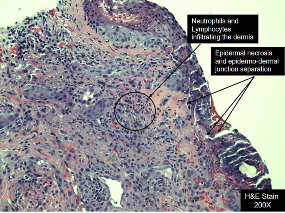 Skin punch biopsy specimen showing necrotic keratinocytes, full-thickness epidermal necrosis, and epidermo-dermal junction separation, accompanied by neutrophils and lymphocytes dermal infiltrate.