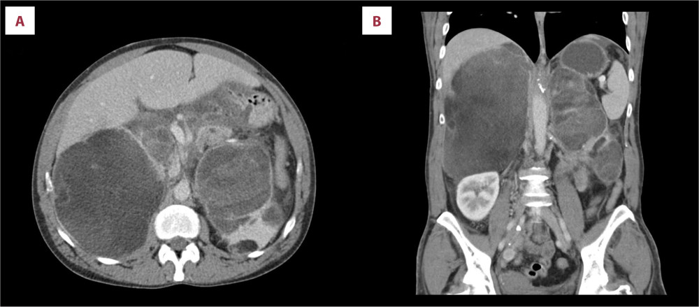 Torso CT scan, Axial (A) and Coronal (B) CT scans showing massive bilateral retroperitoneal tumors with a volume of approximately 161×131×200 mm on the right side and 124×66×186 mm on the left side.