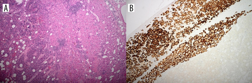 Section of the tumor. (A) Hematoxylin and eosin: right side of the picture with characteristics of a hyperplastic adrenal cortex, left side of the picture with characteristics of a myelolipoma. (B) Immunohistochemistry, Melan A antibody positivity.