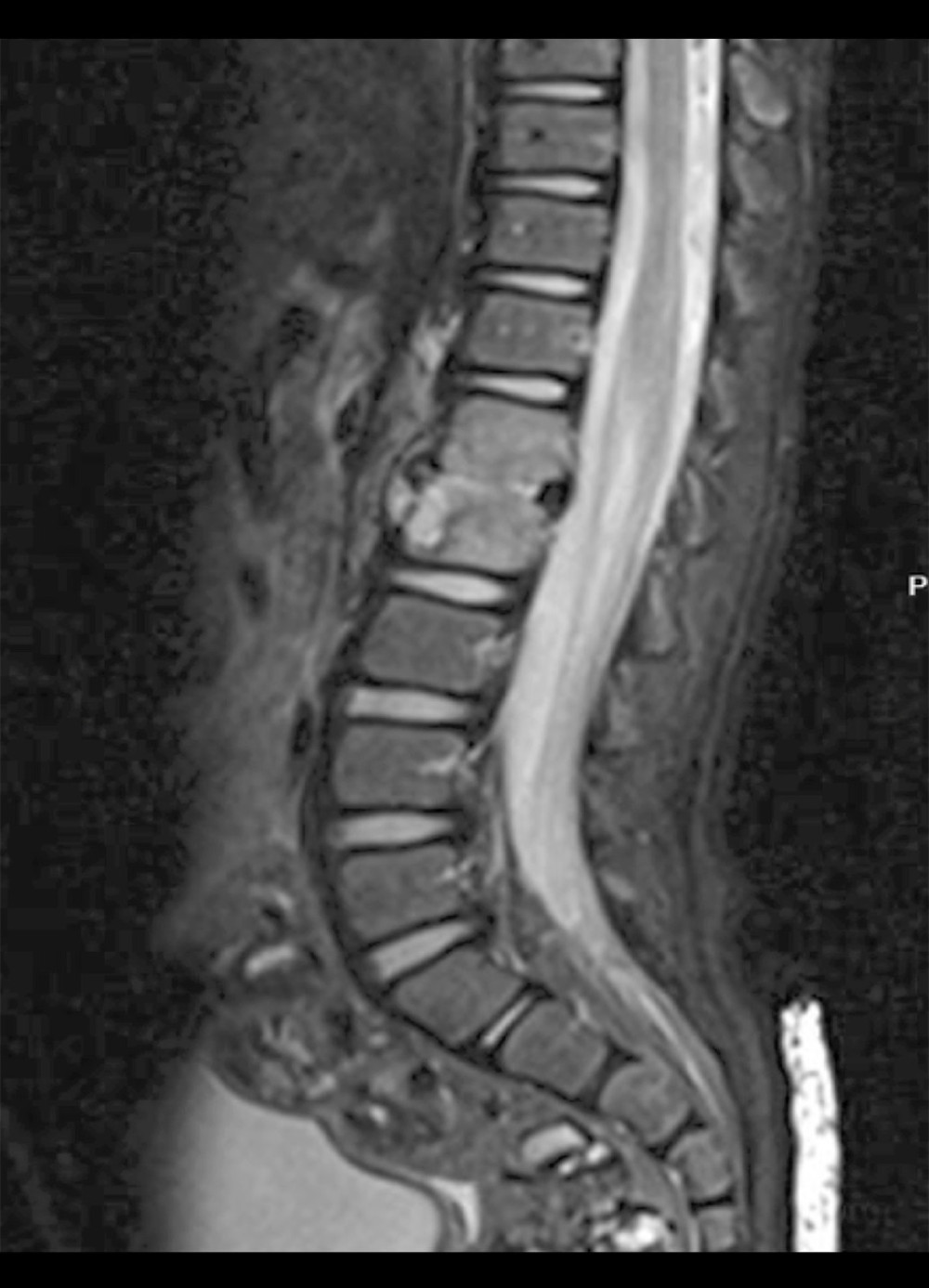 Lumbar spine MRI of a 21-month-old child with spondylodiscitis. Initial magnetic resonance imaging (MRI) of the lumbar spine with contrast, in which transverse relaxation time (T2) sequence sagittal view of the lumbar spine shows changes at lumbar vertebrae 1 (L1), while lumbar vertebrae 2 (L2) suggests spondylodiscitis associated with a small intervertebral disc collection.