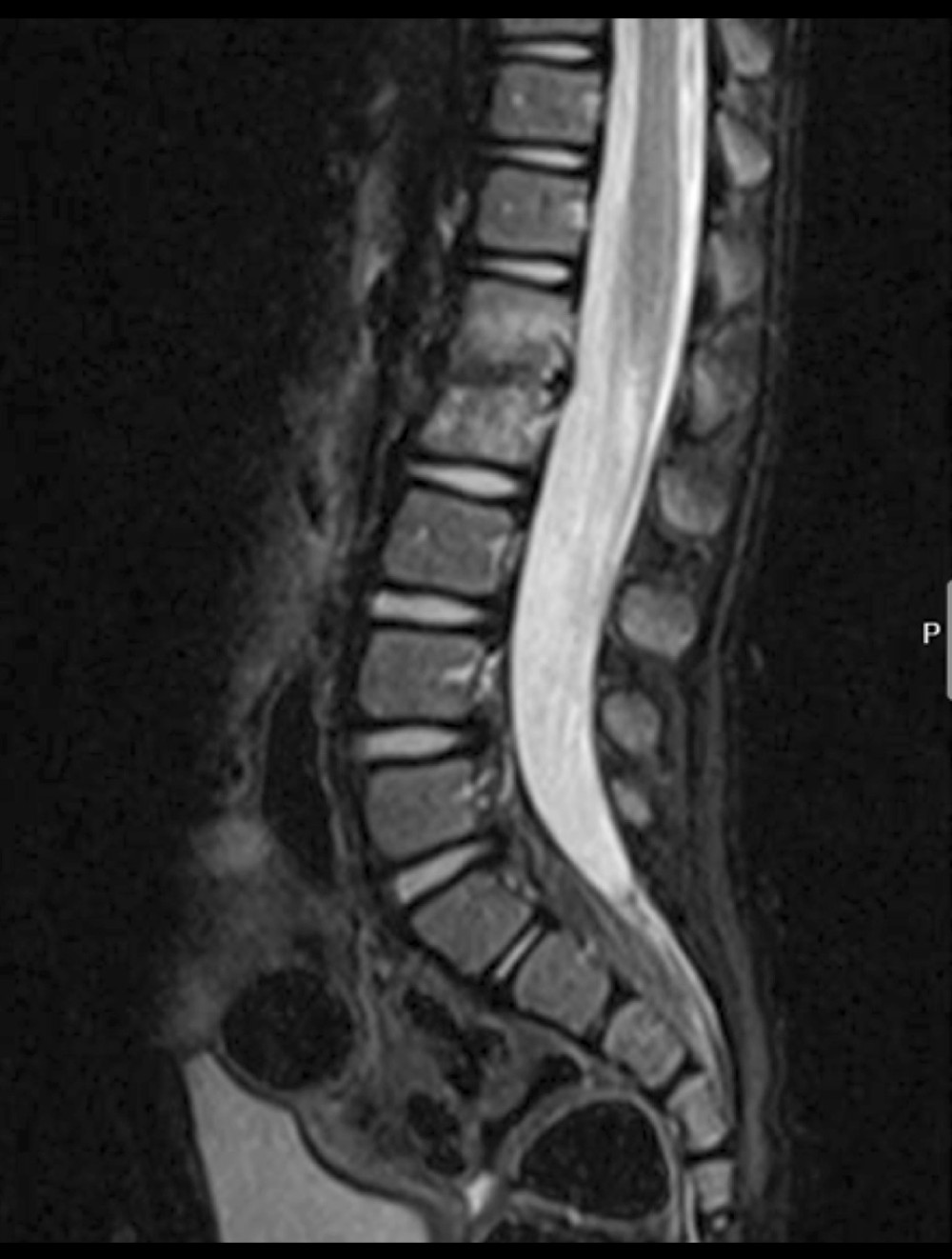 Lumbar spine MRI of a 21-month-old child with spondylodiscitis. Follow-up repeated MRI of the lumbar spine with contrast performed. T2 sequence sagittal view of the lumbar spine MRI showing significant reduction of the marrow edema and intervertebral disc collection at L1-L2 after 6 weeks of antibiotic therapy.