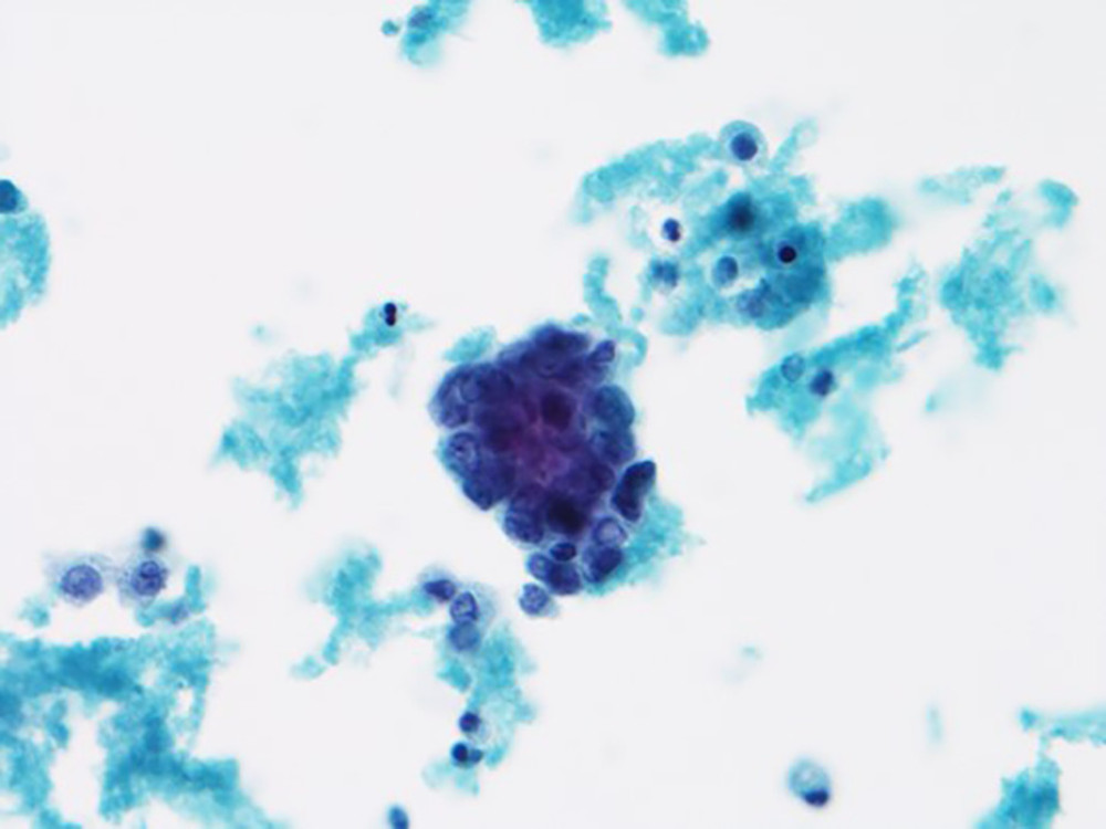 A small 3-dimensional cluster of cells with scant cytoplasm, enlarged hyperchromatic cells with nuclear overlapping, irregular nuclear contours, and high N: C ratios. Cytology smear, DQ stain, 60×.