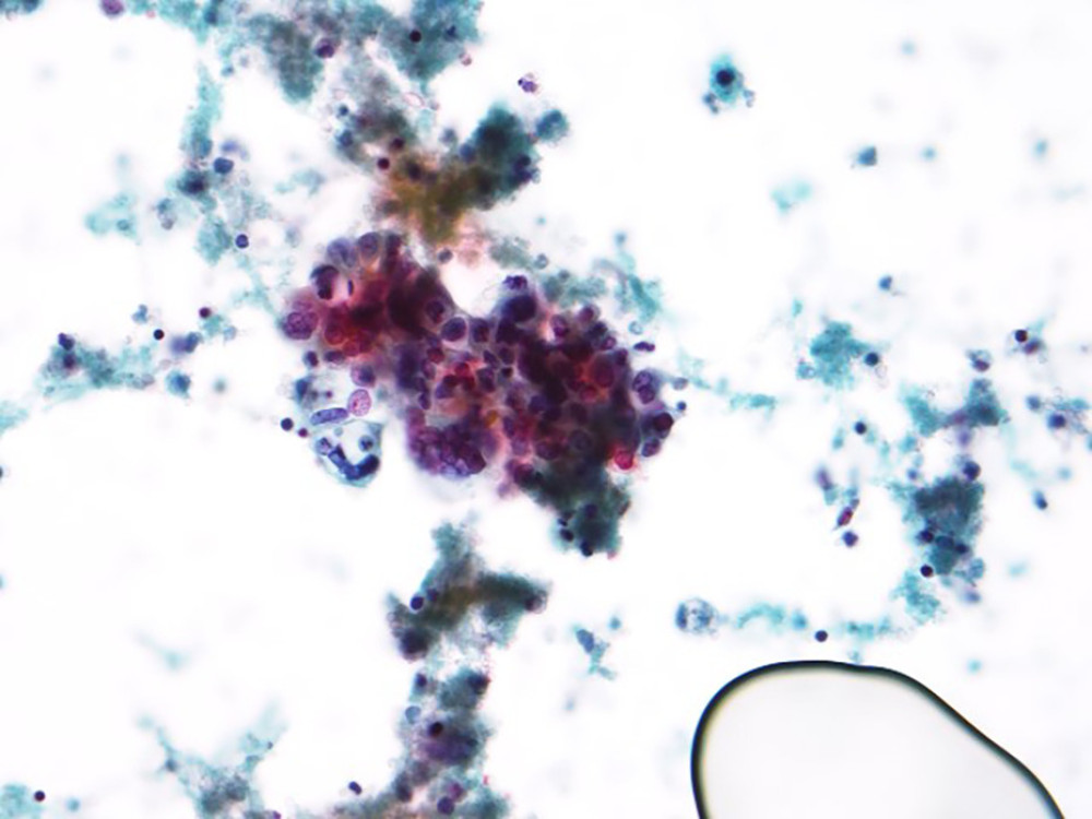 A cluster of atypical cells with scant dense cytoplasm, hyperchromatic nuclei, irregular nuclear contours, and high N: C ratio. The cytoplasm of the cells in the cluster demonstrates orangephilia. Cytology smear, Pap stain, 60×.