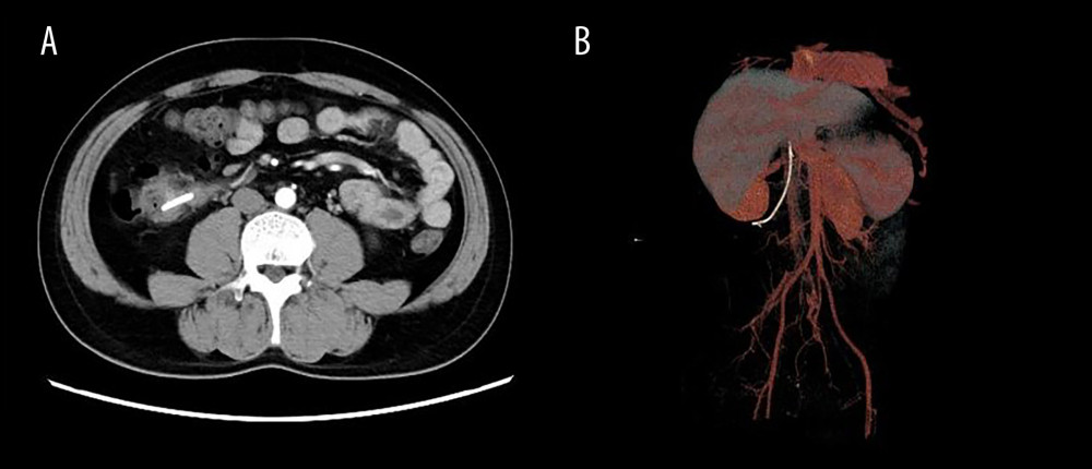 (A) Computed tomography (CT) scan displaying a duodenocolic fistula caused by biliary stent displacement; (B) 3D imaging of migrating biliary stents.