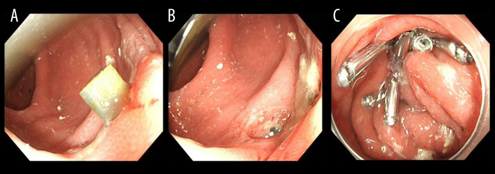 Endoscopic views displaying: (A) A plastic stent passes through the colon wall; (B) A punctate perforation following the stent was inserted into the sinus using foreign-body forceps; (C) The titanium clips that was used to close the perforation.