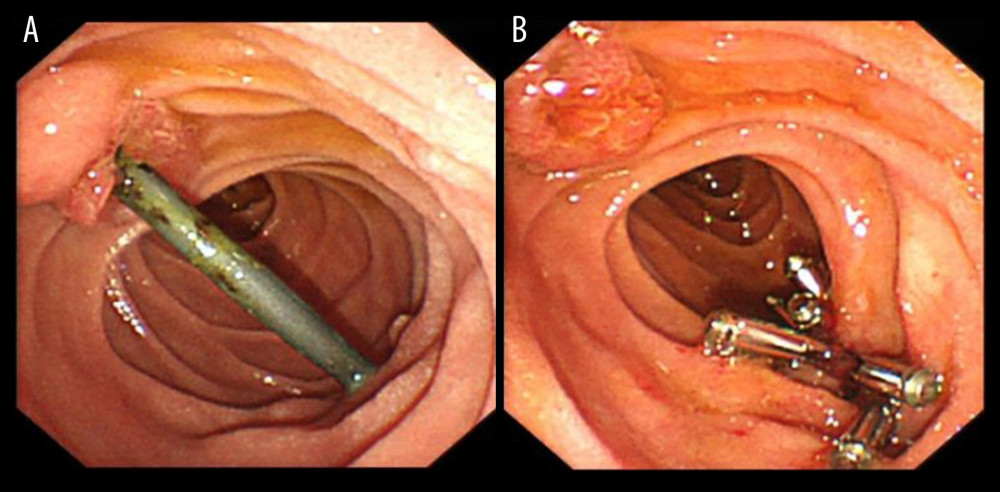 Endoscopic views: (A) A bile duct stent could be seen crossing the intestinal cavity in the descending segment of the duodenum; (B) After removing the displaced biliary stent, a punctate perforation was left on the duodenal wall and closed with a titanium clip.